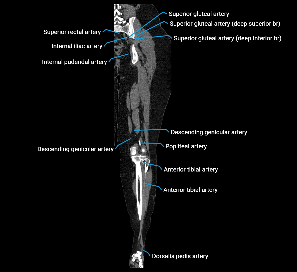 CTA lower limb coronal cross sectional anatomy labelled image _56 (2).webp